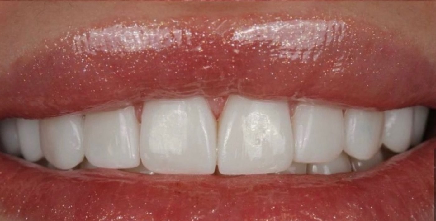 Dopo: faccette in ceramica Belia, forma e colore ricostruiti