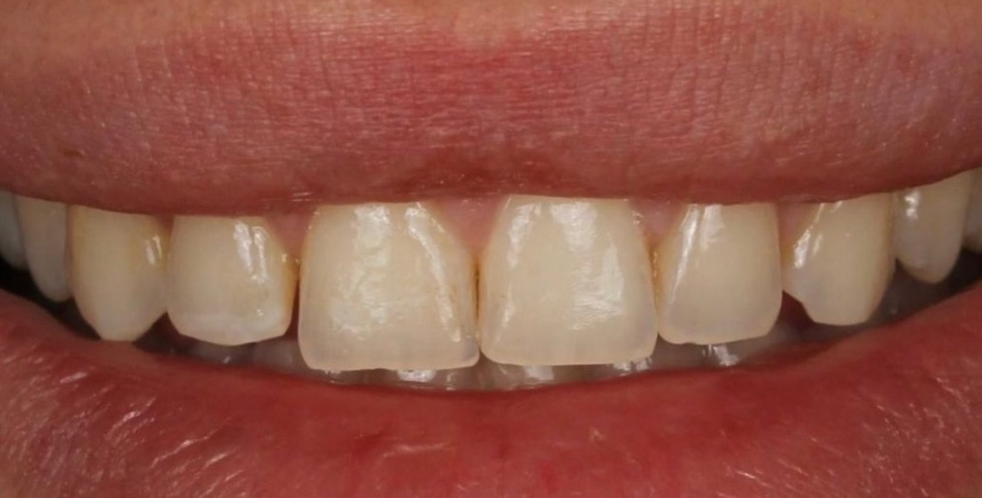 Prima: denti naturali con bordi consumati e colore disomogeneo