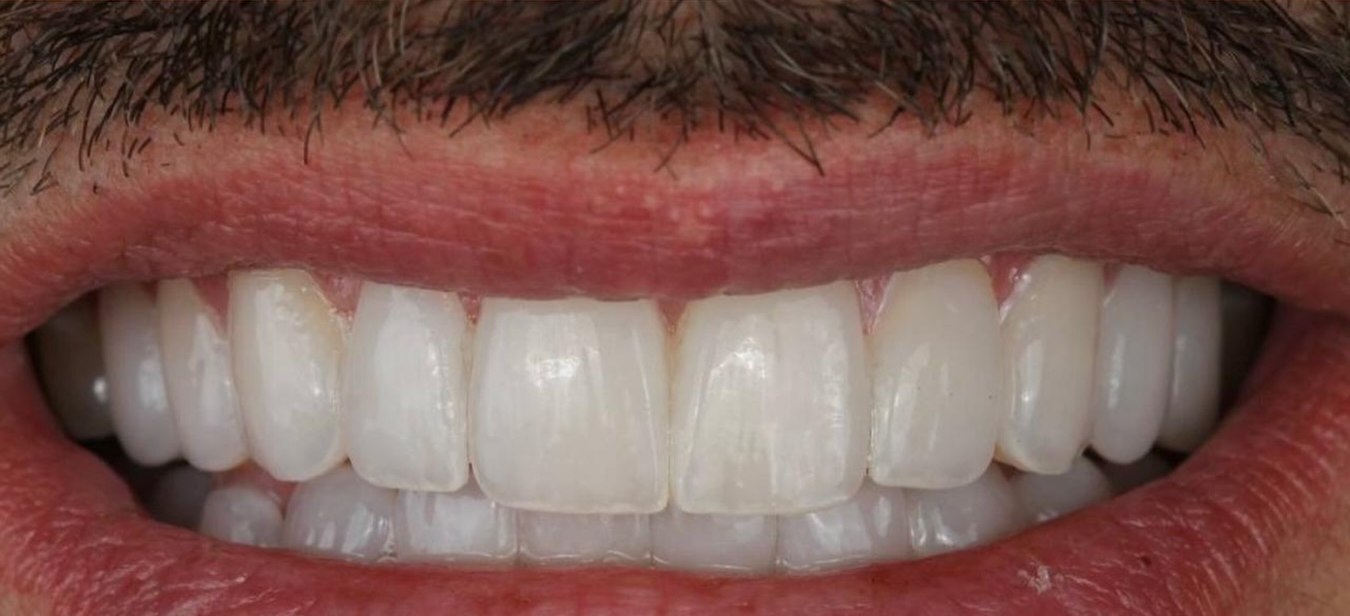 Dopo il trattamento: faccette in ceramica Belia