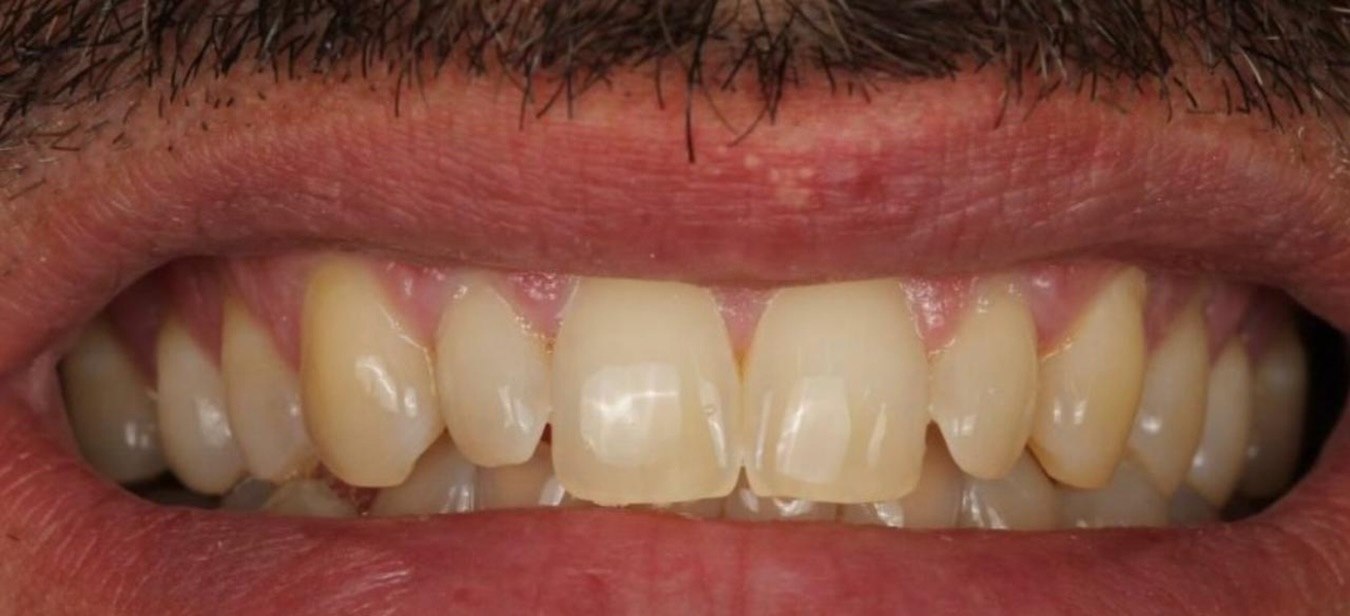 Prima del trattamento: denti naturali ingialliti