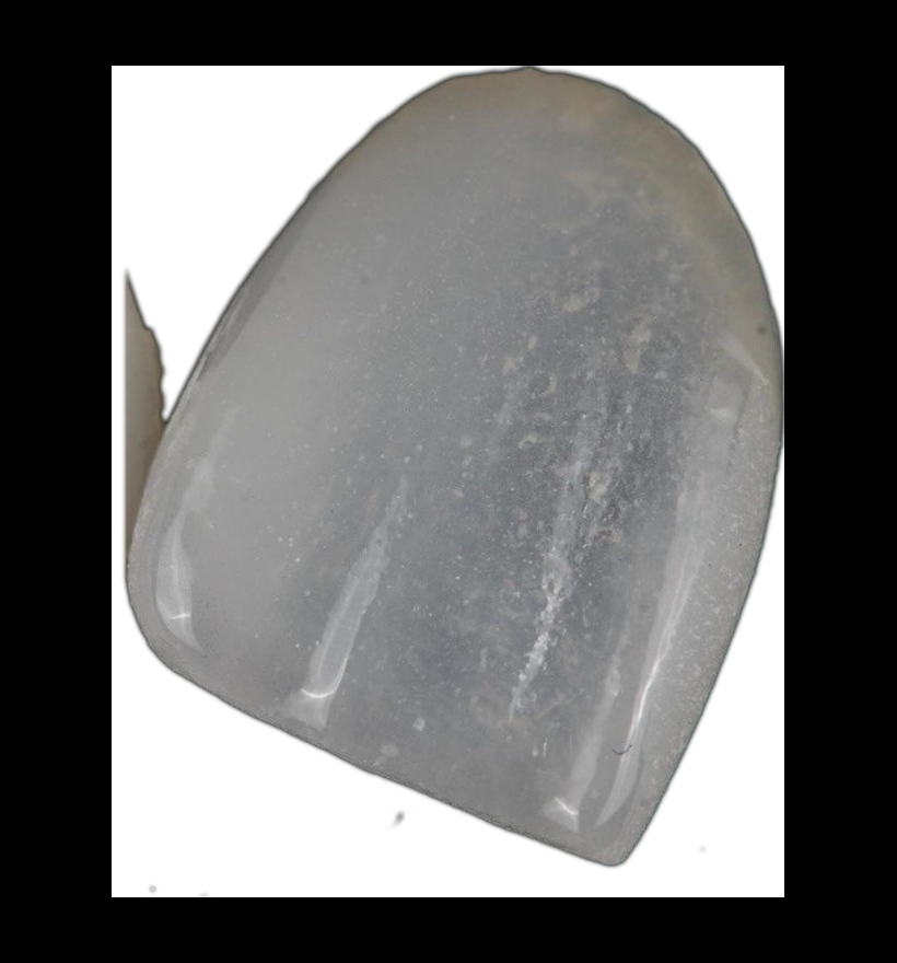 Faccetta Belia: ceramica traslucida, il nero si vede attraverso