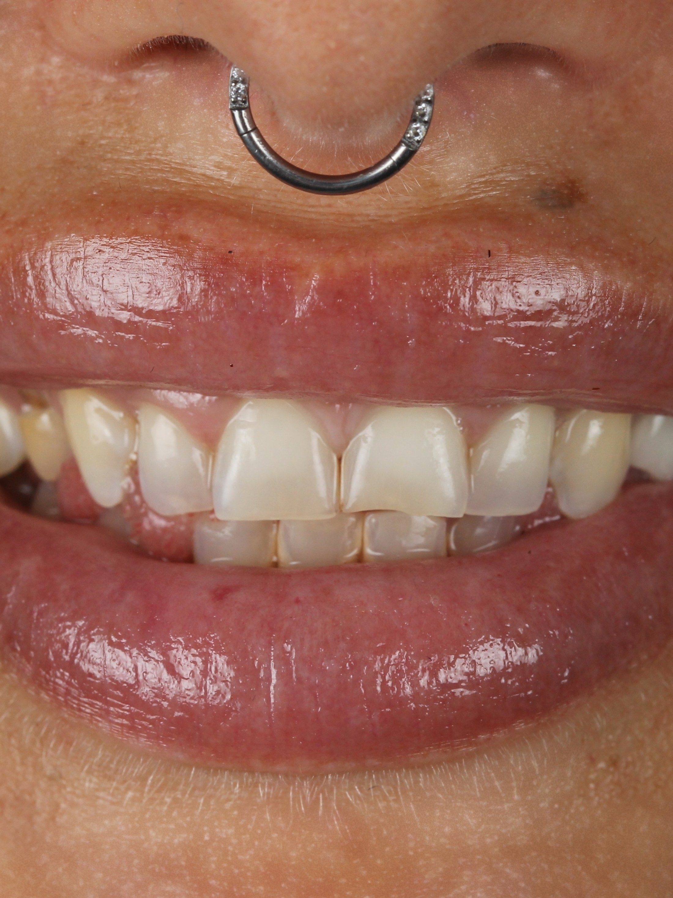 Prima del trattamento: denti irregolari e ingialliti, un incisivo laterale ruotato.
