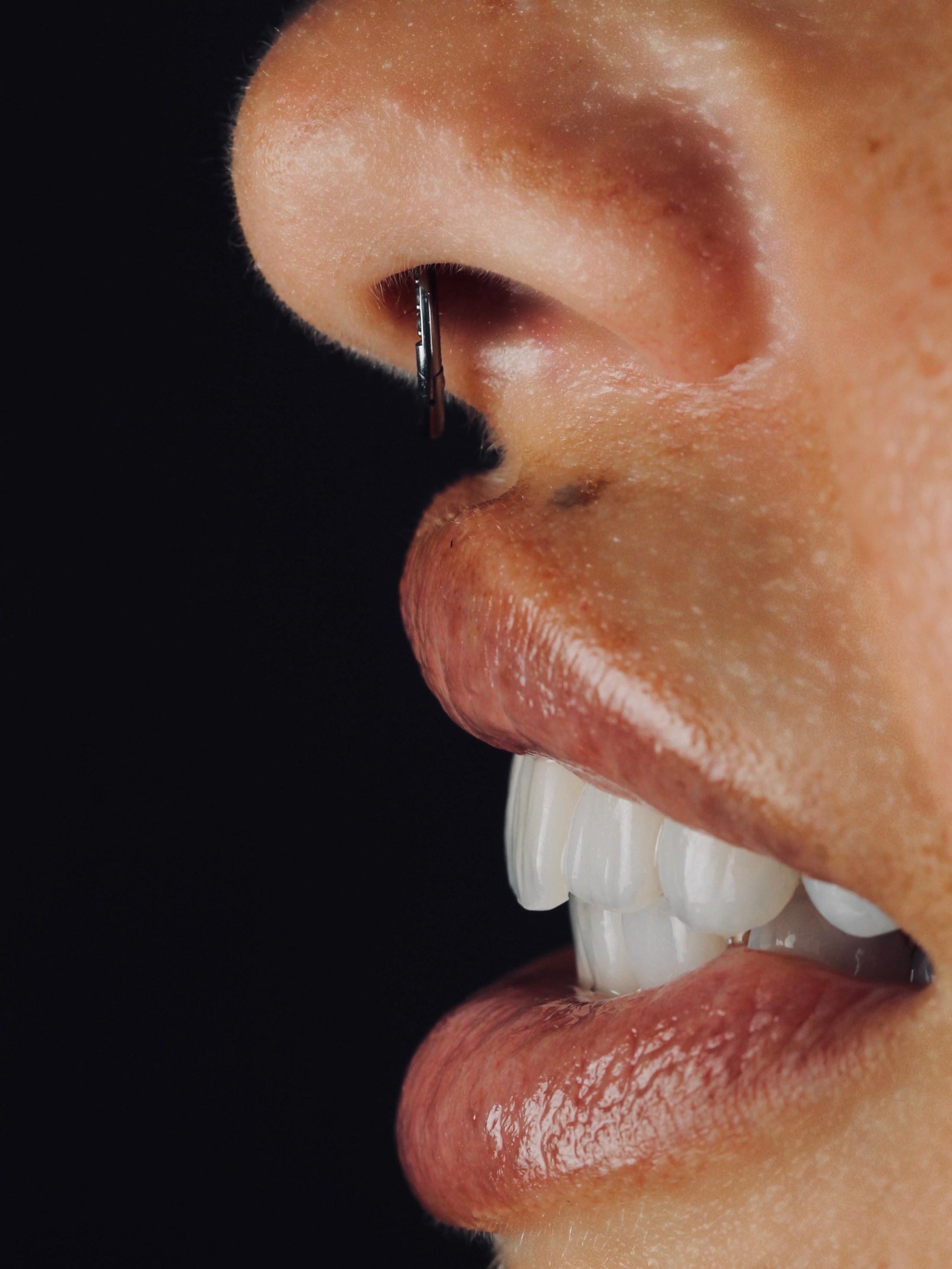 Lo stesso sorriso di profilo: si vede lo spessore della ceramica sul bordo dei denti.