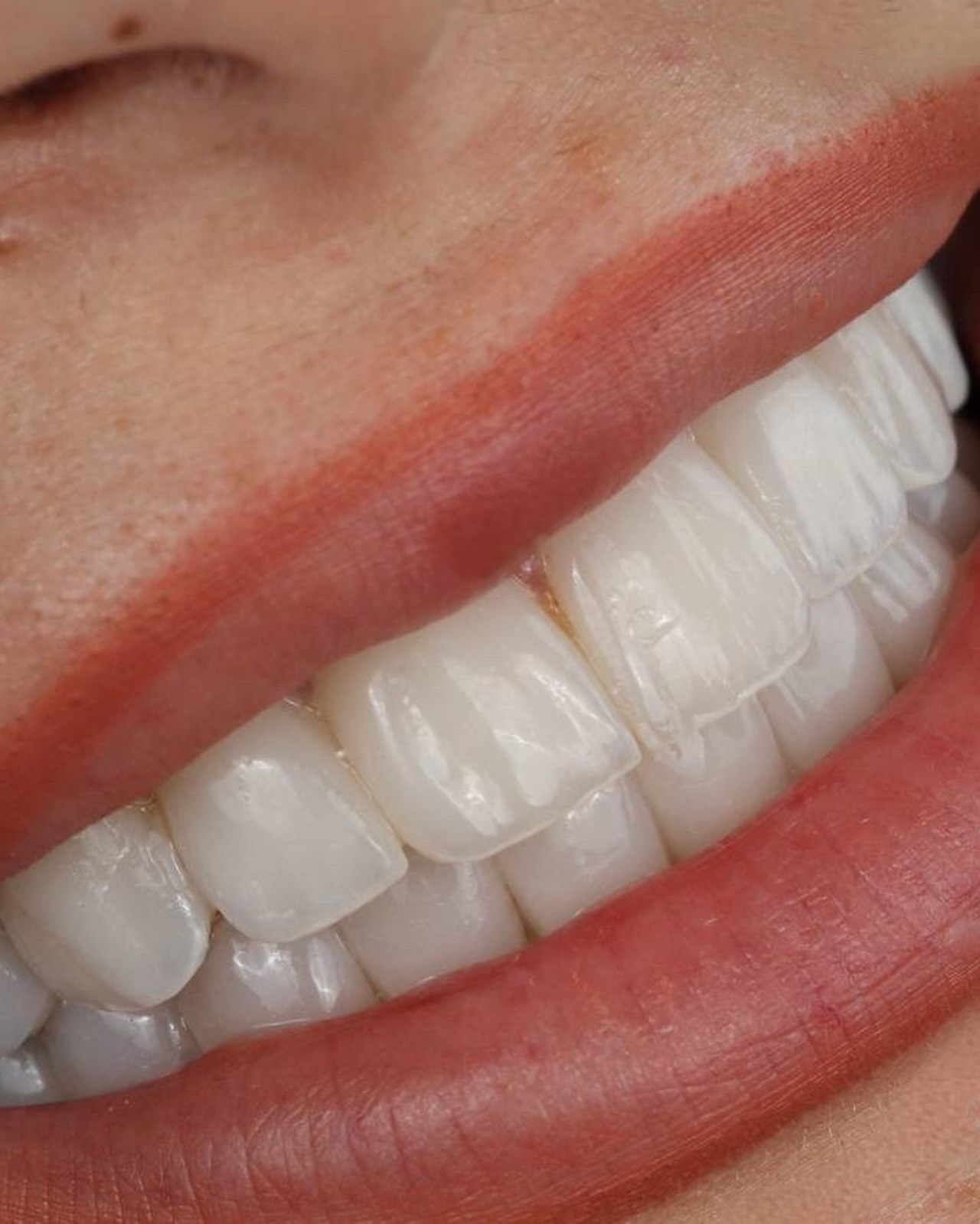 Macro di un sorriso con faccette: sul bordo dei denti la ceramica diventa grigio-azzurra dove la luce la attraversa.